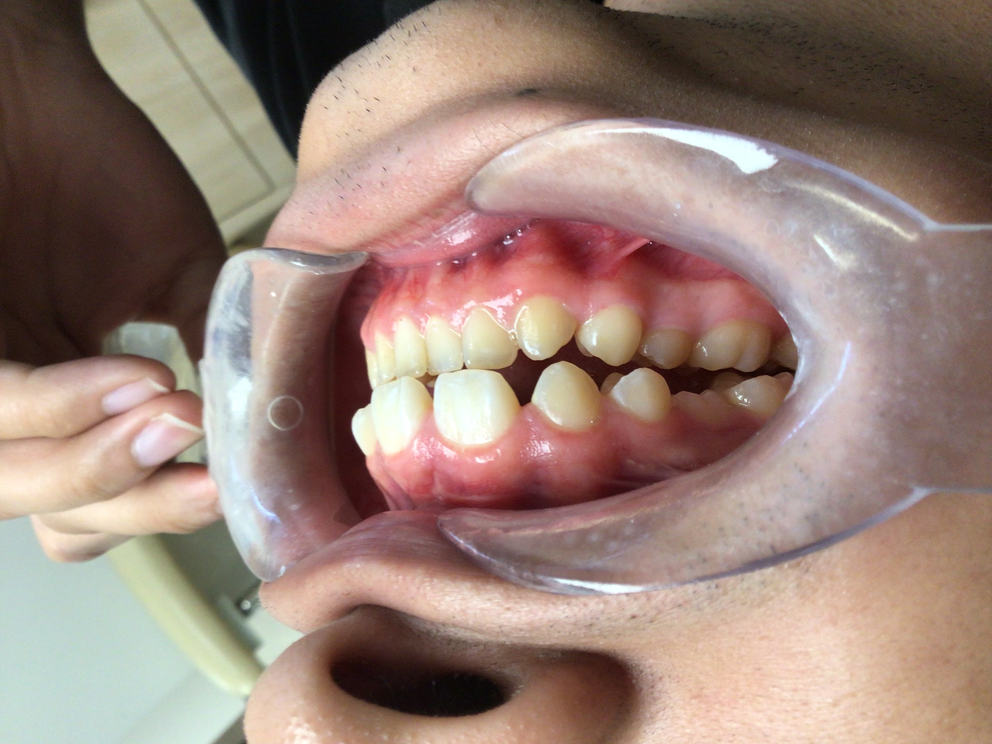 Before Invisalign Treatment